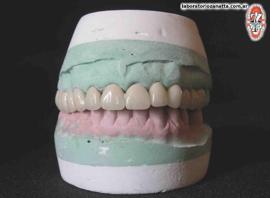 Prótesis fijas | Laboratorio Dental Alberto Zanatta