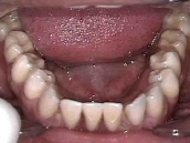 Laboratorio Dental - trabajo-muestra-4