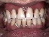 Laboratorio Dental - trabajo-muestra-5